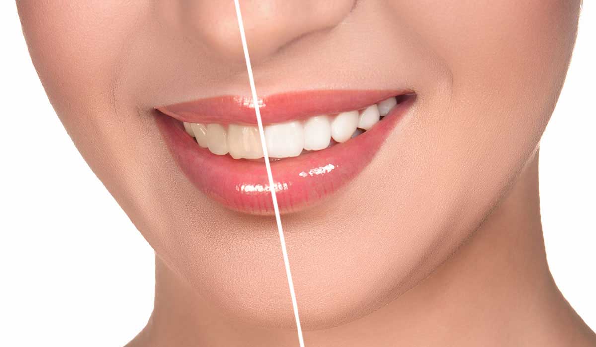 Teeth whitening