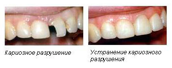 лечение кариеса